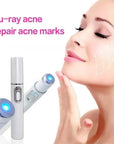 Blue Light Therapy Acne Laser Pen