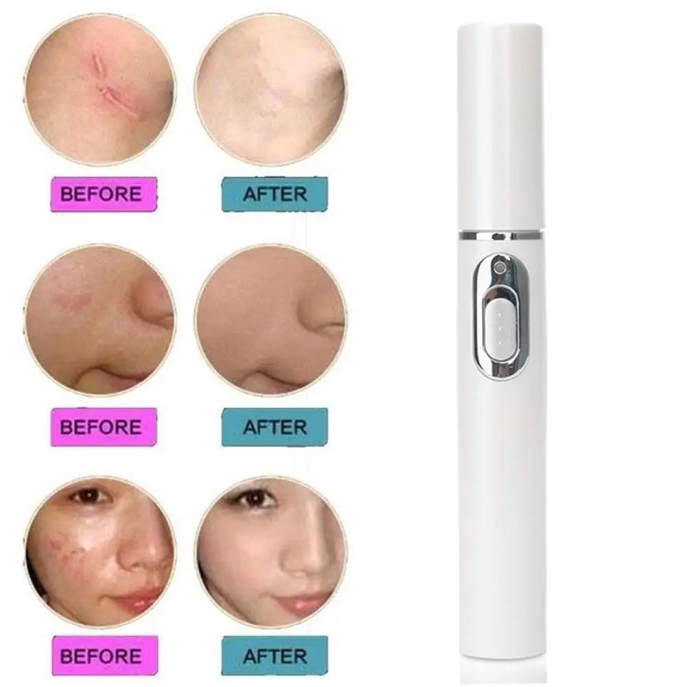 Blue Light Therapy Acne Laser Pen