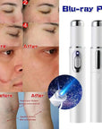 Blue Light Therapy Acne Laser Pen